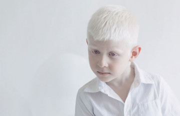 Albino hastalığı nedir?