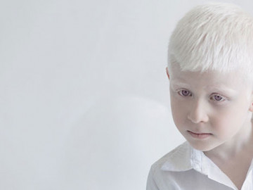 Albino hastalığı nedir?